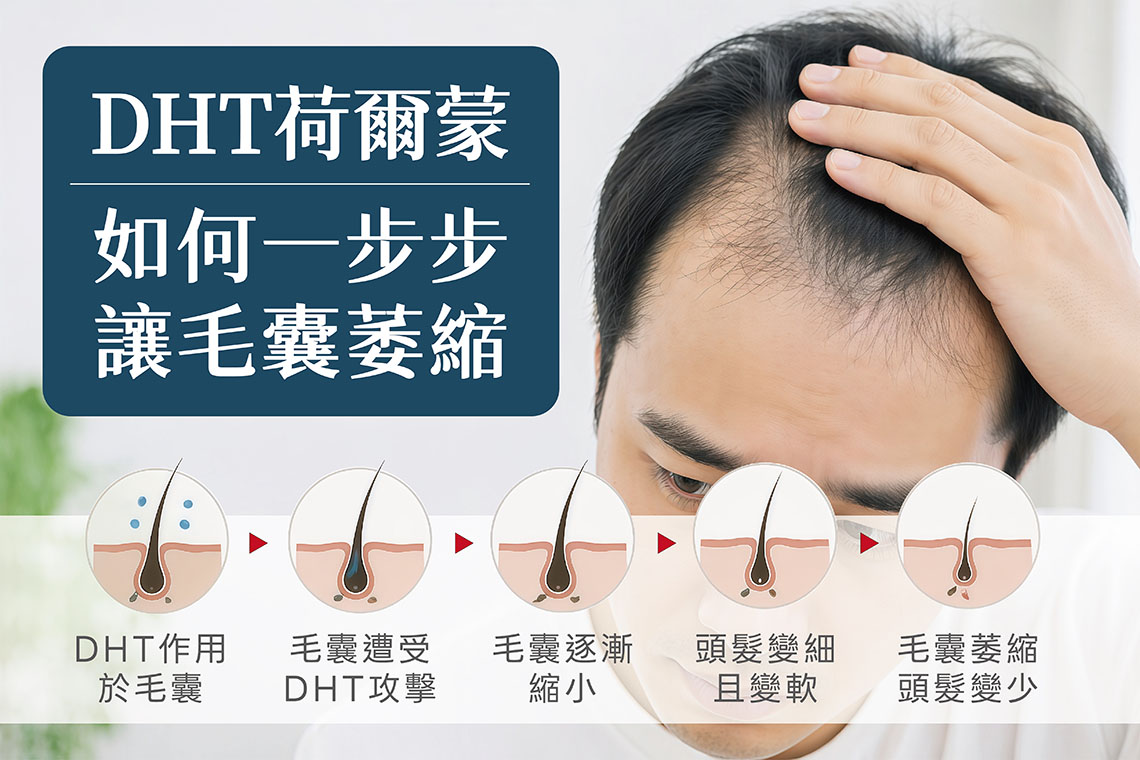 在所有男性掉髮原因中，雄性禿（Androgenetic Alopecia） 佔了極高比例，也是最容易被忽略、卻最需要及早介入的落髮類型。而雄性禿的成因，是一種與賀爾蒙與遺傳體質密切相關的慢性毛囊退化過程。