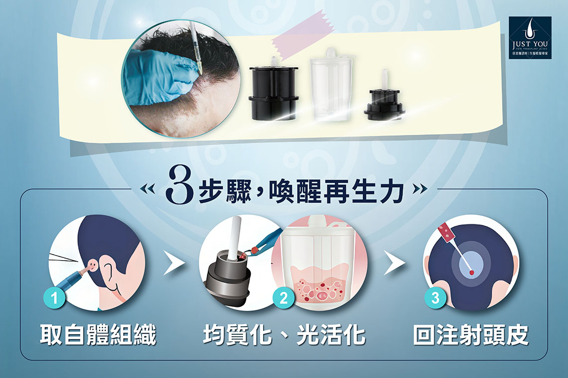 GCell 魔髮艙三步驟喚醒再生力 GCell 魔髮艙三步驟:1.取自體組織、2.均質化與光活化、3.回注射頭皮