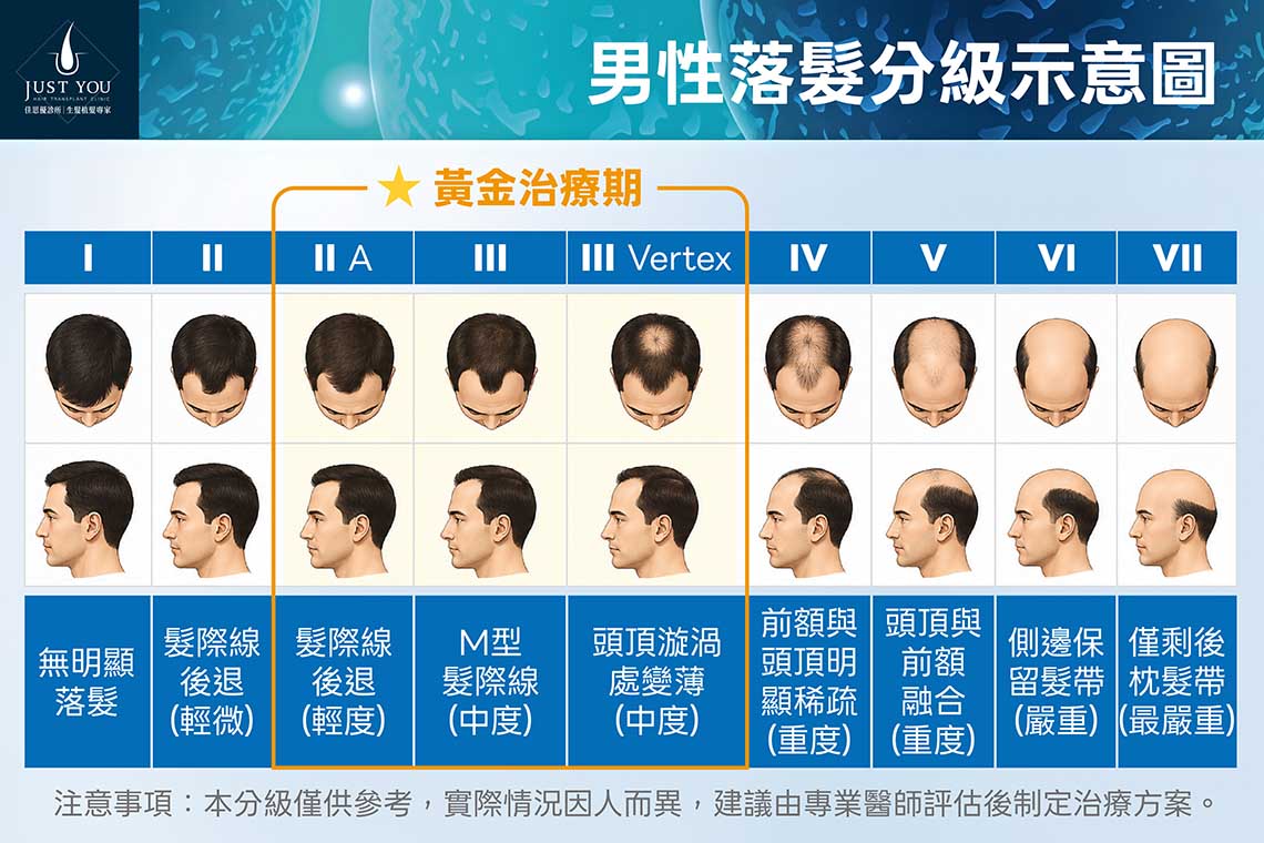 男性落髮分級示意圖 把握落髮第一刻、毛囊還在的黃金治療期,是育髮養護的好時機。