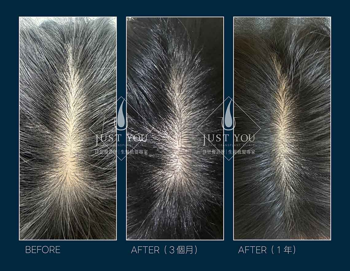 複合式生髮 佳思優素人分享複合式生髮-治療術前術後狀況