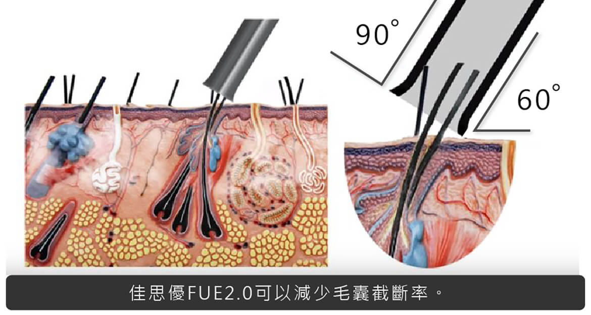 佳思優FUE2.0可以減少毛囊截斷率 減少毛囊截斷率-掉髮改善推薦