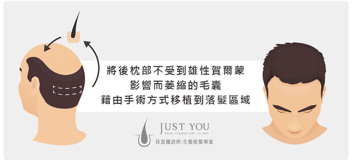 植髮手術原理-掉髮改善推薦