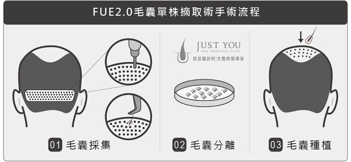 FUE2.0 植髮手術3步驟 FUE2.0 植髮手術-掉髮改善推薦