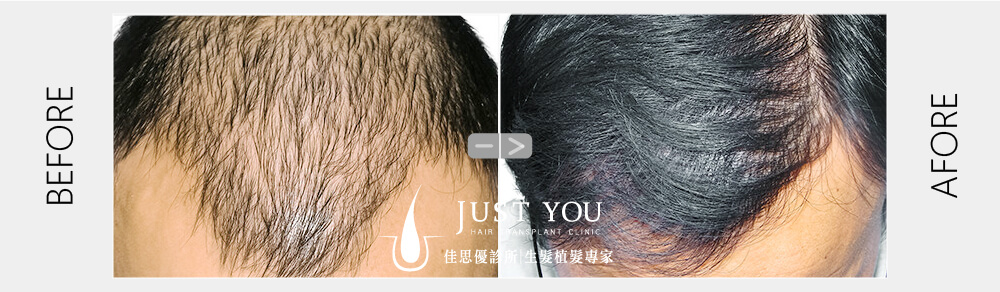 ARTAS植髮機器案例 ARTAS植髮機器植髮案例-掉髮改善推薦