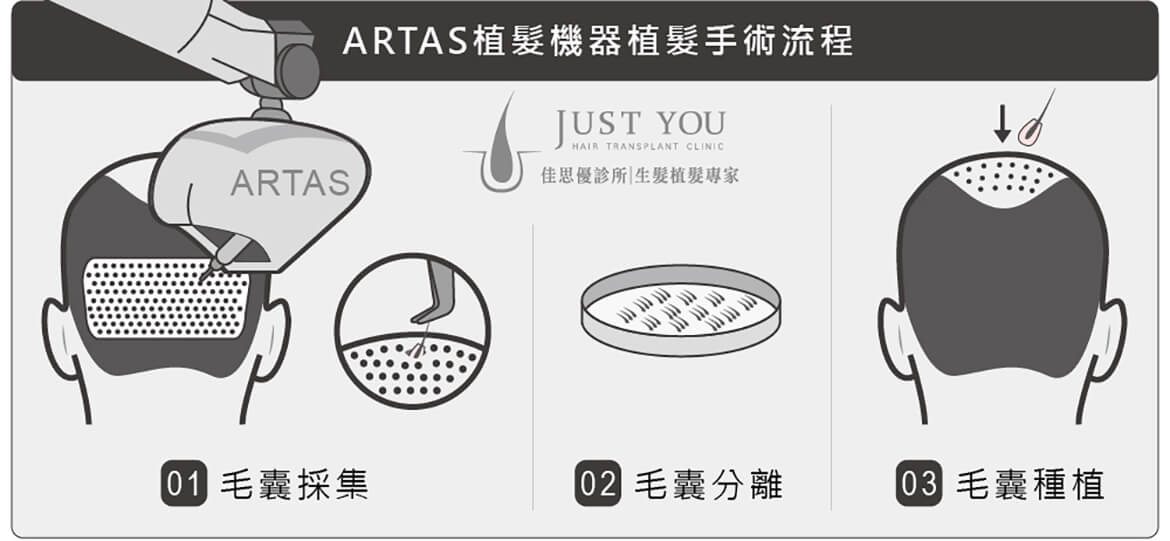 ARTAS植髮機器植髮手術流程 ARTAS植髮機器植髮手術流程-掉髮改善推薦