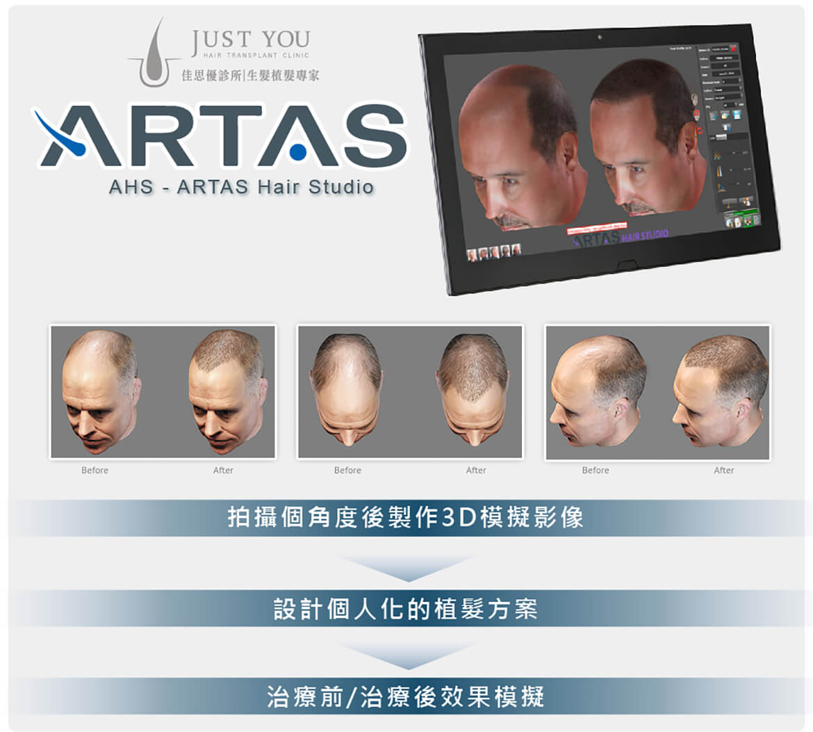 ARTAS植髮手術3D影像模擬技術 ARTAS植髮手術3D影像模擬技術-掉髮改善推薦