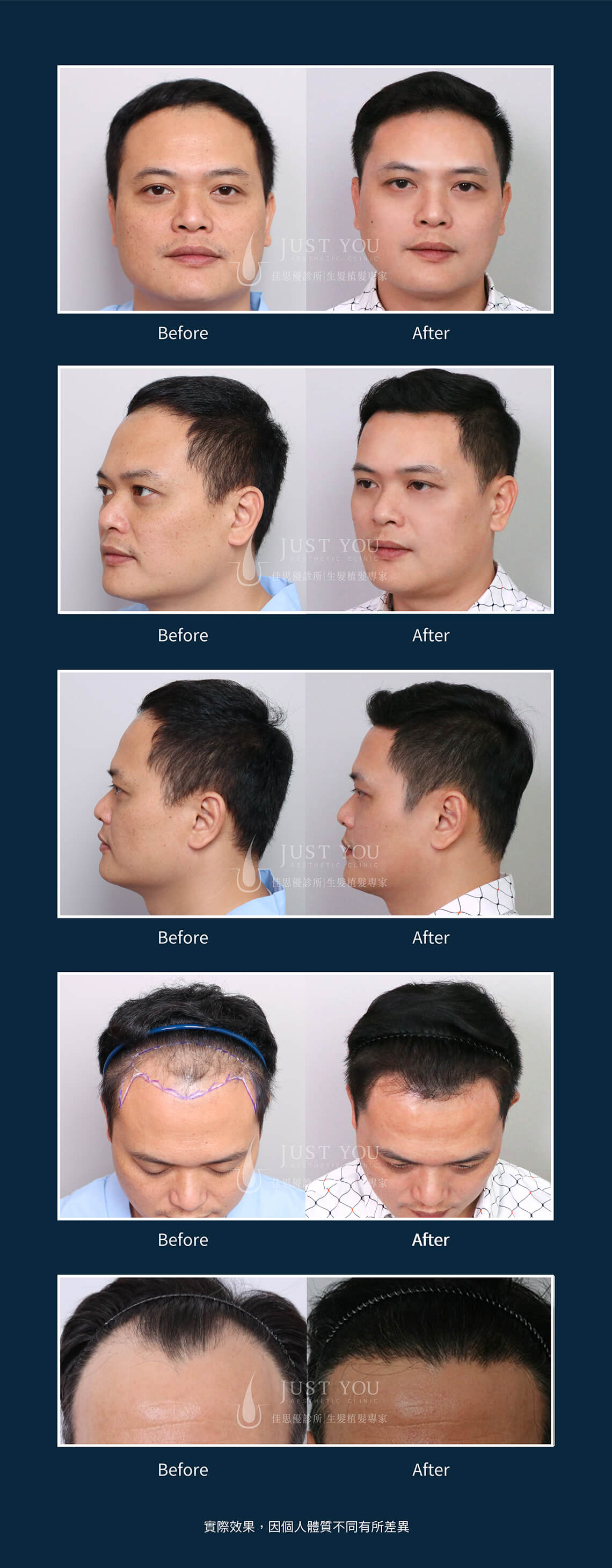 FUT植髮手術案例