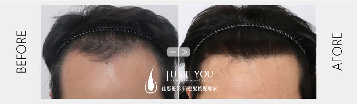 PCID寇約翰植髮手術案例-M型禿治療推薦