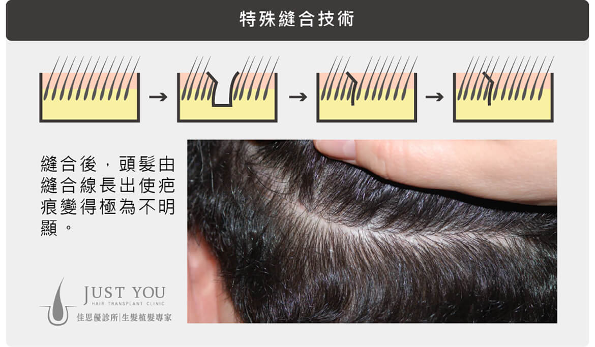 FUT植髮手術傷口特殊縫合技術-M型禿治療推薦