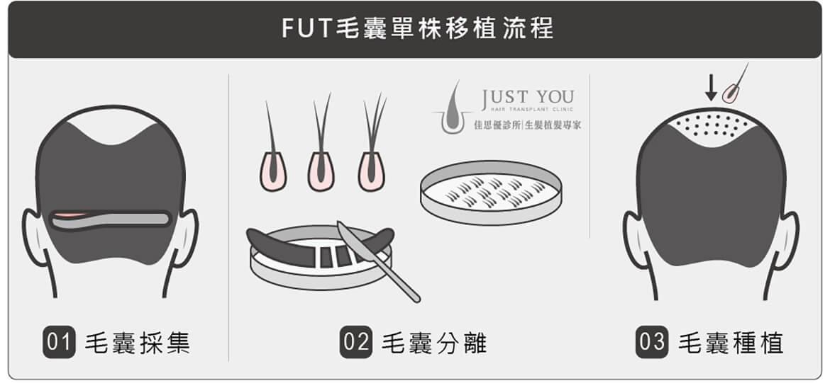 FUT毛囊單株移植手術流程-M型禿治療推薦