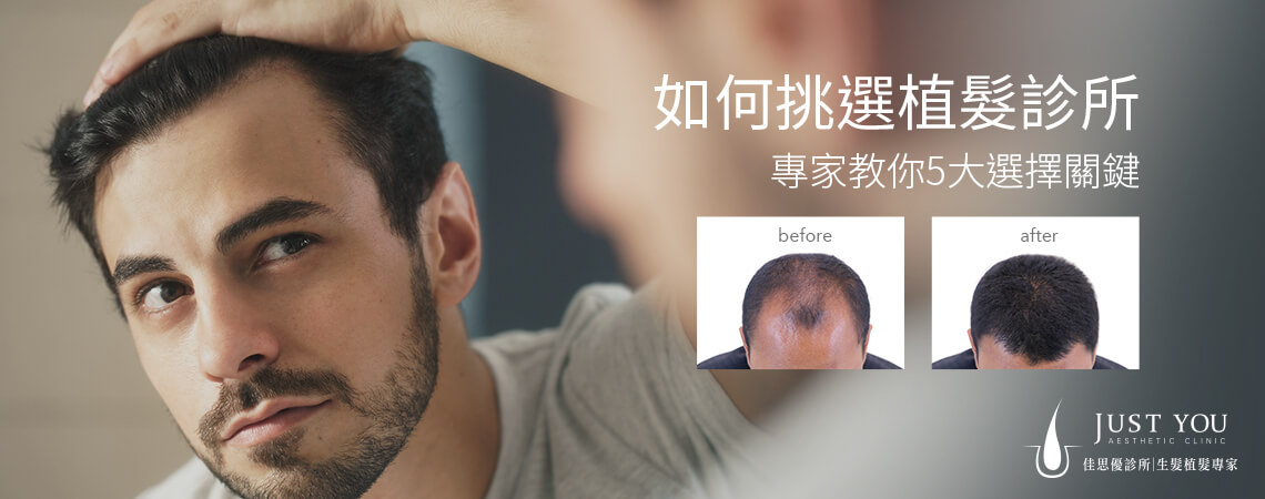 植髪診所怎麼挑-掉髮改善推薦